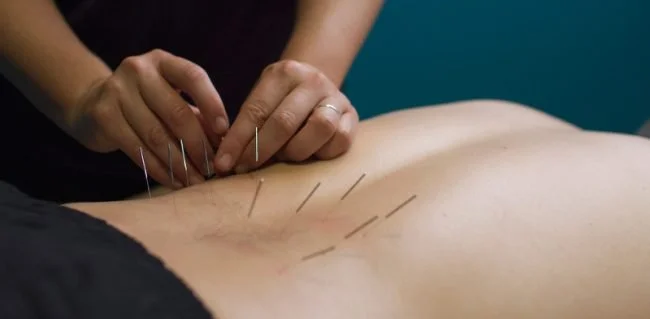 Dry-Needling-2000x980-smaller-650x319 - Radiant Chiropractic Canterbury