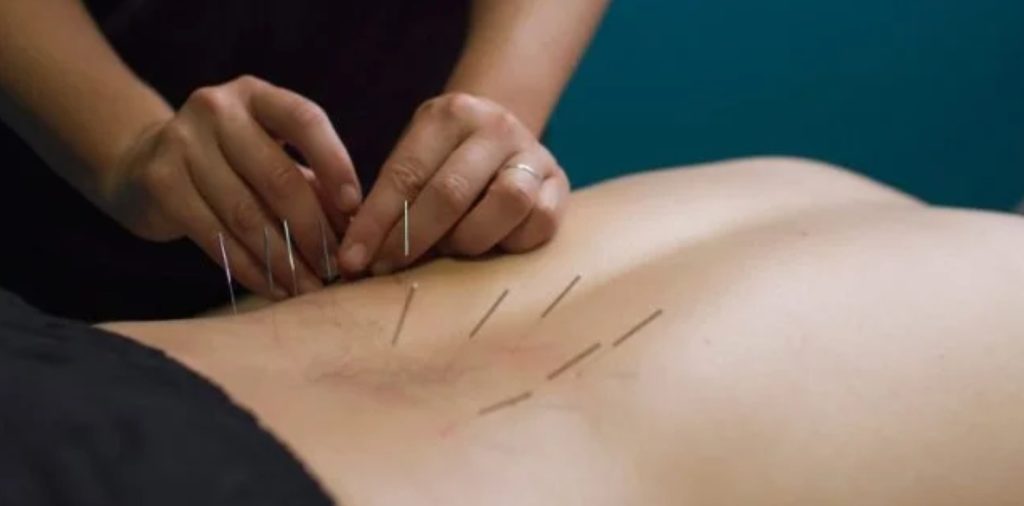 Practitioner performing dry needling by inserting thin needles into a patient’s lower back muscles
