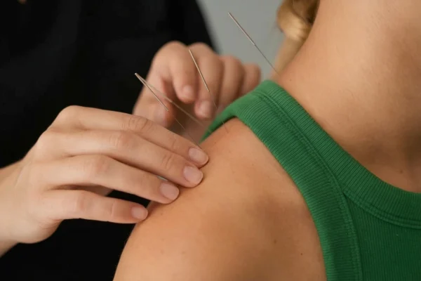 Dry needling technique used on shoulder muscles to address muscle tightness and trigger points