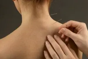 Dry needling treatment applied to the upper back muscles